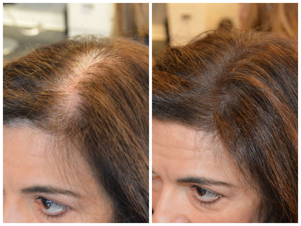 scalp color for thinning hair 2019 – forensicanth